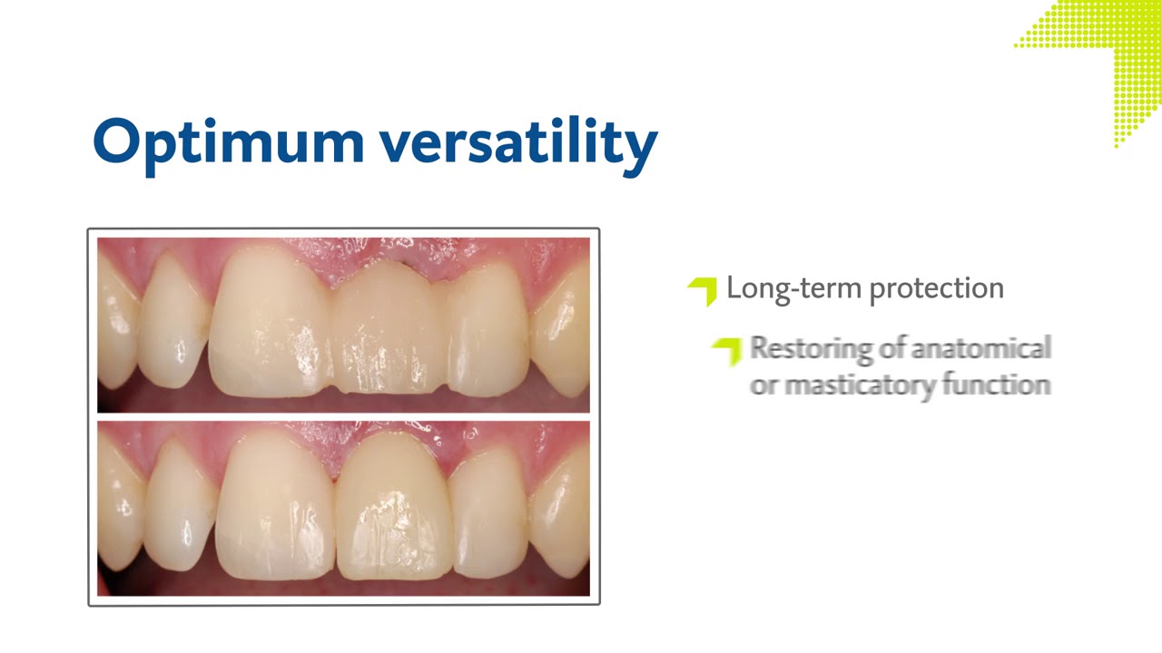 LuxaCrown by DMG The easiest way to long lasting crowns
