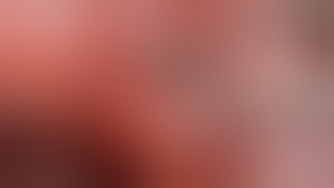 Biportal VATS Fissureless Right Lower Lobectomy For NSCLC (Alternative technique incomplete fissure)