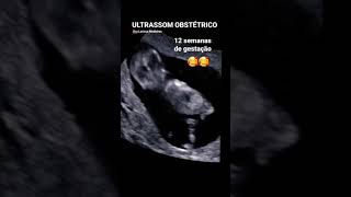 12 SEMANAS DE GESTAÇÃO (mexendo muito 😆) | Ultrassom obstétrico screenshot 3