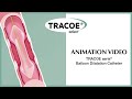 TRACOE Animation Video aeris Balloon Dilation Catheter