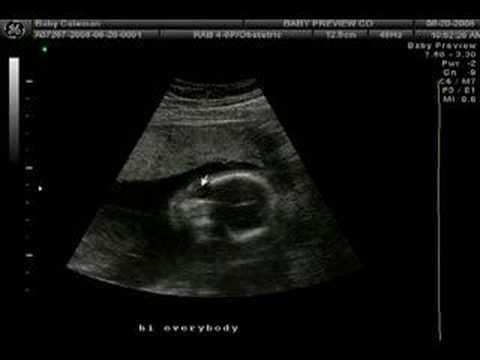 Baby Isaac - 20 Weeks