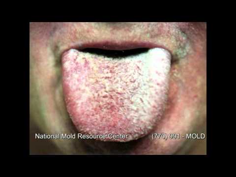 The Symptoms of Mold Exposure and Mold Illness from Black Toxic Mold Exposure