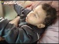 الشلل الدماغي أطفال ينتظرون الموت 