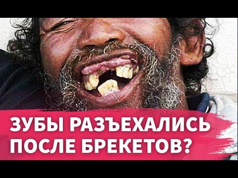 Зубы разъехались после брекетов? Ретейнеры, капы.