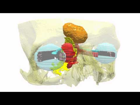 Navigacijska 3D-CA-RP-FESS - operacija nosa, sinusa, orbite i baze lubanje