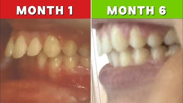 Fixing Deep Bite Naturally (full guide)