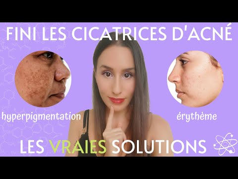 Vidéo: 10 Aliments Pour Réduire Les Poussées D'acné, Les Cicatrices Et L'hyperpigmentation