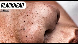 Pure Popping!  Blackheads, Pimples, Big Zits and Eye Cysts!  Nonstop Pop!