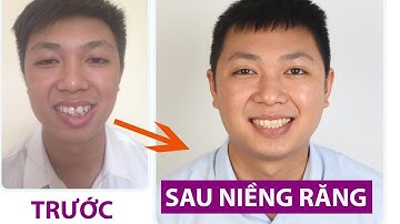 { THÁO MẮC CÀI} Không tin vào niềng răng chữa răng lệch lạc, khấp khểnh