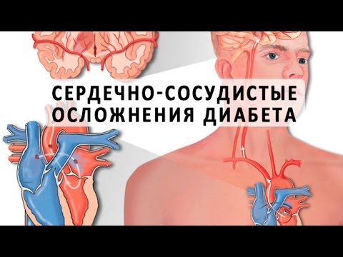 Сахарный диабет и сердечно-сосудистые осложнения