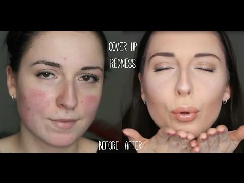 Make-Up Tutorial for Rosacea || Party Camouflage + Contouring Make-up