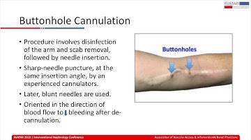 Cannulating AV Access, Button holes, self cannulation & plastic needles | Dr. Lalathaksha Kumbar