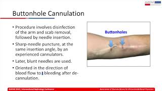 Cannulating AV Access, Button holes, self cannulation & plastic needles | Dr. Lalathaksha Kumbar