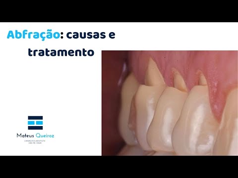 Vídeo: Defeito Dentário Em Forma De Cunha - Tratamento, Motivos, Como Tratar Em Casa