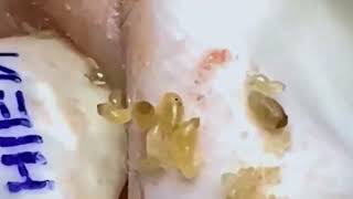 Acne Removal Transformation | Get Clear, Glowing Skin Fast #0037