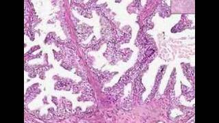 Histopathology Prostate--Intraepithelial neoplasm (PIN)