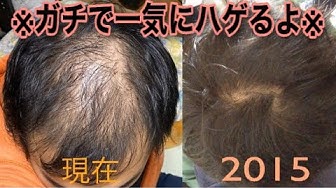 つむじハゲ Youtube