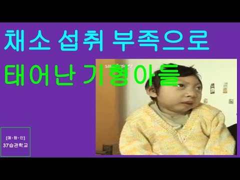 매탐인 기형아 - 엽산 부족 식습관 때문에 태어나는 기형아