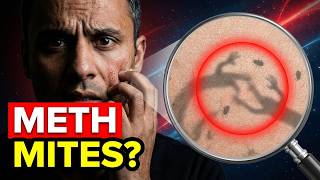 The Truth About Meth Mites Nobody Talks About