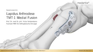 APTUS Foot Hallux System 2.8 Lapidus Arthrodese TMT-1 Medial Fusion OP Technik