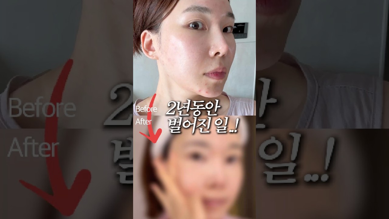 화장품에 수억원 쓴 민감피부가 레티놀을 2년 넘게 쓰고 생긴 일