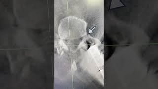 Treating Recurrent Disc Herniations