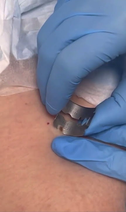 Shaving a mole for biopsy at Skin & Beauty Center