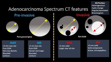 Adenocarcinoma Spectrum