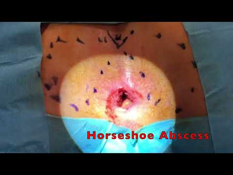 Treatment of Horseshoe Fistula with a two-stage modified Hanley Procedure: a video vignette