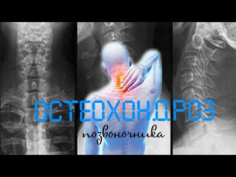 Остеохондроз на рентгене фото. Остеохондроз: рентген как ведущий метод диагностики заболевания. Cимптомы грудного остеохондроза - признаки страшной болезни Рентген шейного отдела позвоночника — Цена в Москве в НКЦ№2 (ЦКБ РАН)