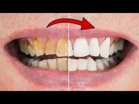 Video: 3 Möglichkeiten, Teeflecken von den Zähnen zu entfernen