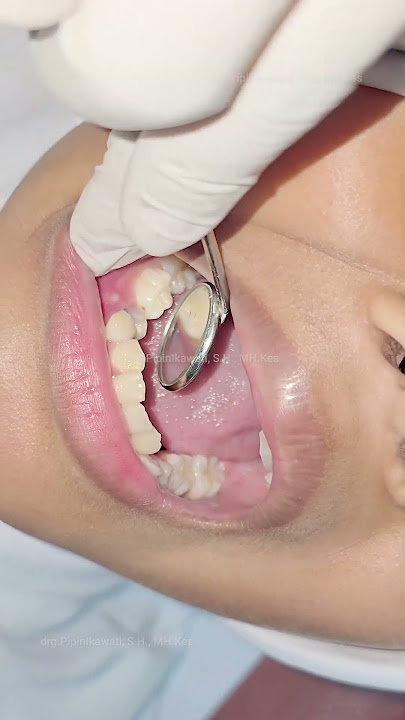 CHILDREN'S TEETH ARE LOOSE BECAUSE PERMANENT TEETH HAVE GROWN IN || PART 1 OF 2