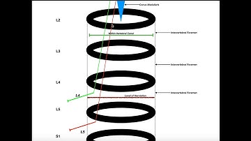 Relation Between Disc Herniation & Compressed Nerve Root Levels