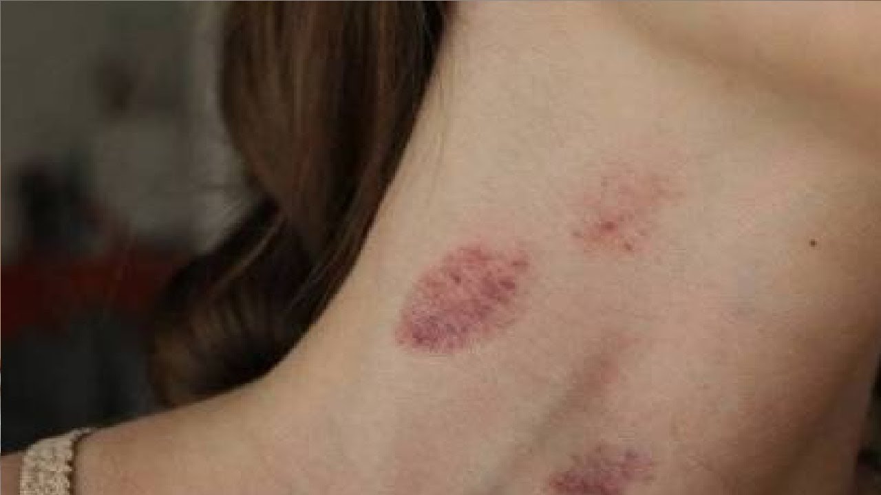 do hickeys get worse before it gets better - YouTube
