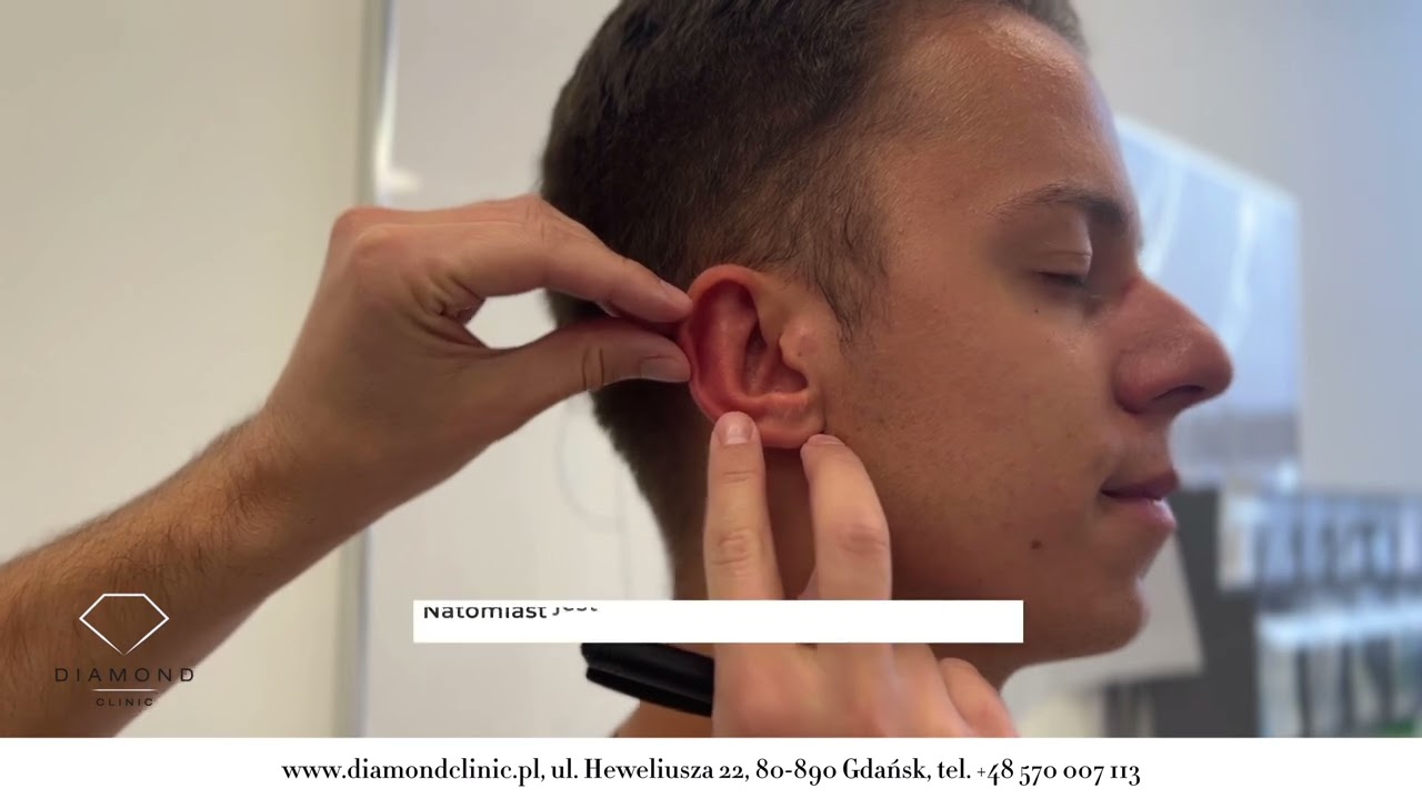 Na czym polega zabieg plastyki odstających uszu