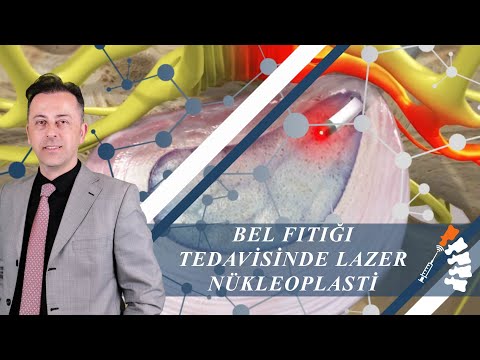 Bel Fıtığı Tedavisinde Lazer Nükleoplasti