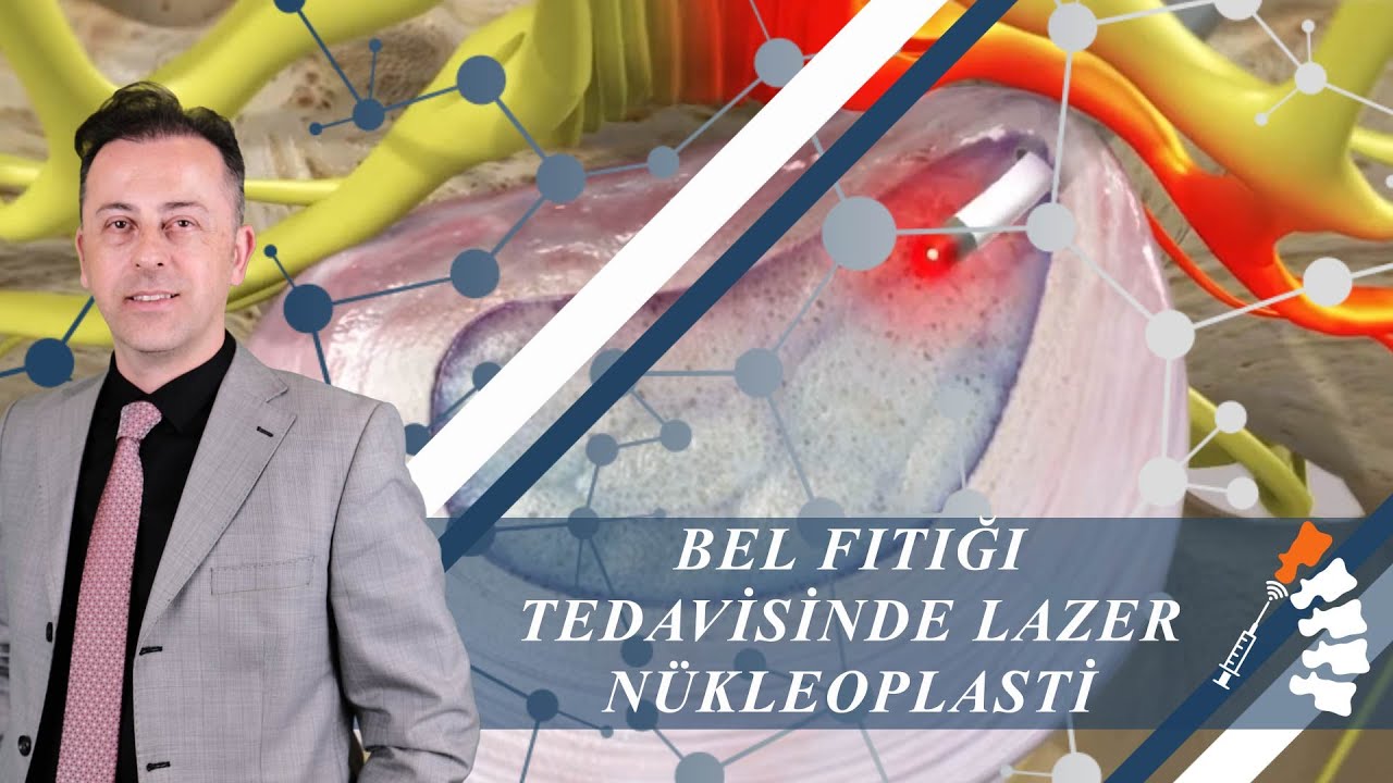 Bel Fıtığı Tedavisinde Lazer Nükleoplasti
