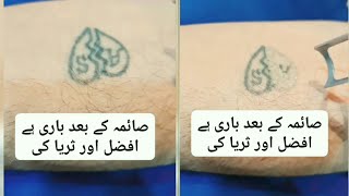 خال (Tattoo) کا جدید لیزر سے خاتمہ