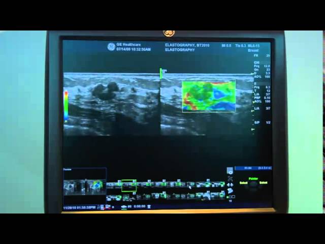 GE Healthcare LOGIQ E9 Elastography demo