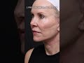 What to Expect From a Facelift