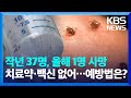 “물리지 않는 게 최선”…고온현상에 진드기 급증 [친절한 뉴스K] / KBS  2024.05.24.