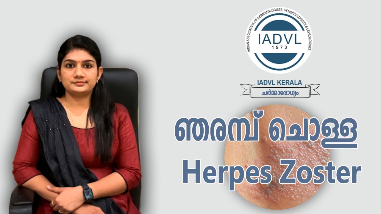 Herpes Zoster- ഞരമ്പ് ചൊള്ള