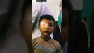 Pre septal cellulitis