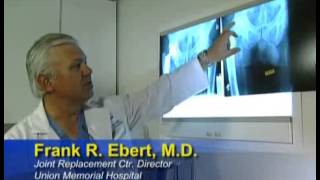 Hip Replacement - MedStar Union Memorial