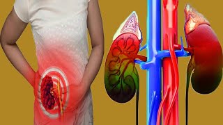 Chronic Kidney Disease: Causes And Treatment