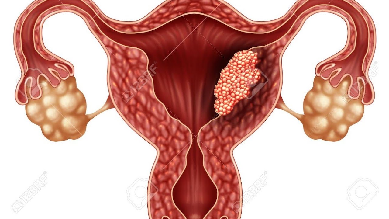 Рак яичников терапия. Злокачественные новообразования яичников. Опухолевые заболевания женских половых органов. Доброкачественные и злокачественные заболевания яичников.