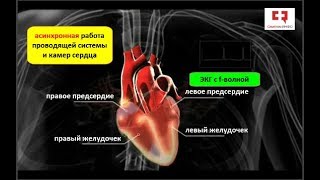 Фибрилляция предсердий или мерцательная аритмия сердца