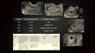 Échographies précoces; critères de datation (M.Althuser)