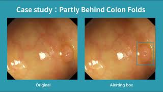 Real-Time Polyp Detection Under Partial Occlusion – Colon Folds
