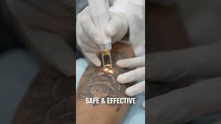 காஞ்சிபுரத்தில் லேசர் மூலம் டாட்டூ அகற்றும் சிகிச்சை | Laser Tattoo Removal @ Sri DKK Hospital⁠